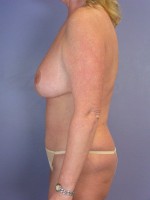 Tummy Tuck Before and after photo