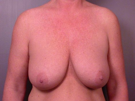 Tummy Tuck before and after photo