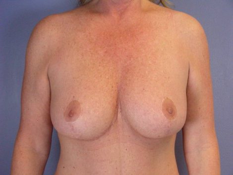 Tummy Tuck before and after photo