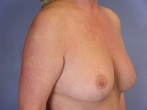 Tummy Tuck before and after photo