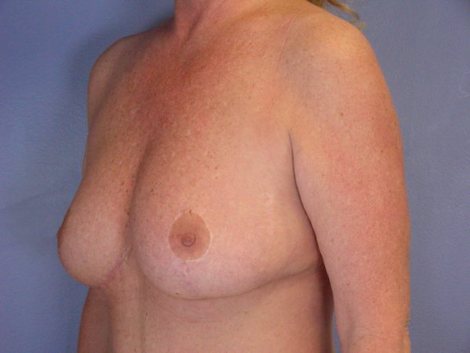 Tummy Tuck before and after photo