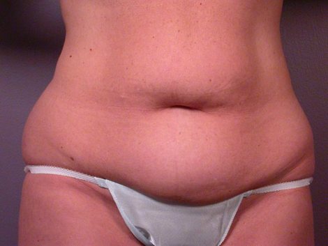 Tummy Tuck before and after photo