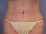 Tummy Tuck Before and after photo