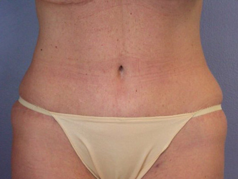 Tummy Tuck before and after photo