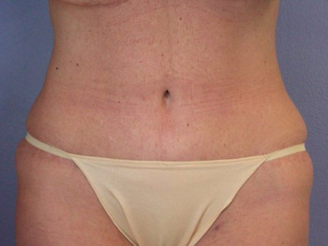 Tummy Tuck before and after photo