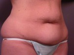 Tummy Tuck Before and after photo