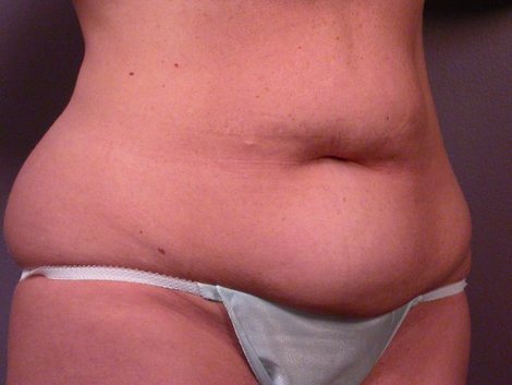 Tummy Tuck before and after photo