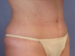 Tummy Tuck Before and after photo