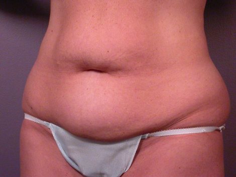 Tummy Tuck before and after photo