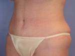 Tummy Tuck Before and after photo