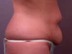 Tummy Tuck Before and after photo