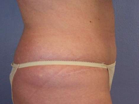 Tummy Tuck before and after photo