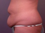 Tummy Tuck Before and after photo