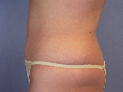 Tummy Tuck before and after photo