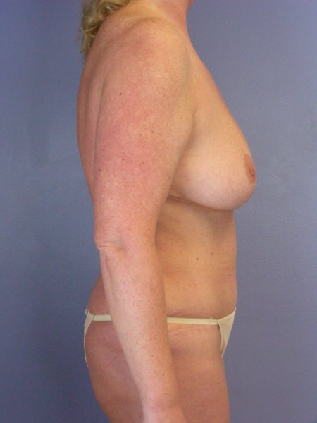 Tummy Tuck before and after photo