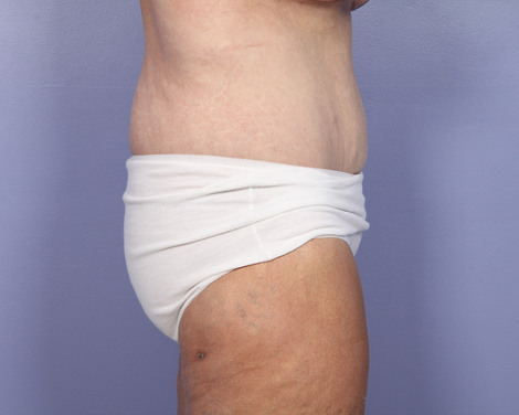 Tummy Tuck before and after photo