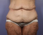 Tummy Tuck Before and after photo