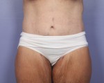 Tummy Tuck Before and after photo