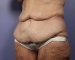 Tummy Tuck Before and after photo