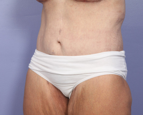 Tummy Tuck before and after photo