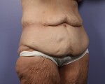 Tummy Tuck Before and after photo