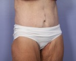 Tummy Tuck Before and after photo