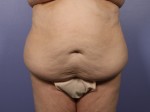 Tummy Tuck Before and after photo