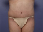 Tummy Tuck Before and after photo