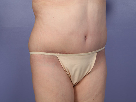 Tummy Tuck before and after photo