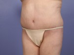 Tummy Tuck Before and after photo