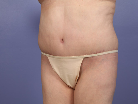 Tummy Tuck before and after photo