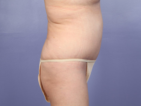 Tummy Tuck before and after photo