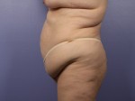 Tummy Tuck Before and after photo