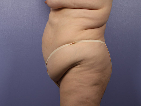 Tummy Tuck before and after photo