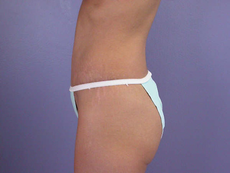 Tummy Tuck before and after photo