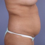 Tummy Tuck Before and after photo