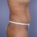 Tummy Tuck Before and after photo