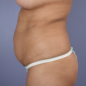 Tummy Tuck before and after photo