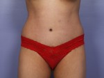 Tummy Tuck Before and after photo