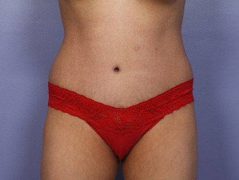 Tummy Tuck before and after photo