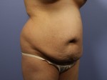 Tummy Tuck Before and after photo