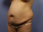 Tummy Tuck Before and after photo