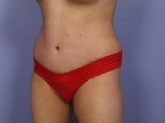 Tummy Tuck Before and after photo