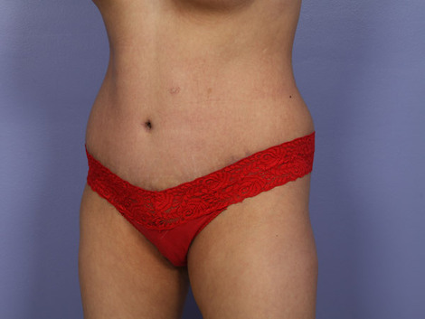 Tummy Tuck before and after photo