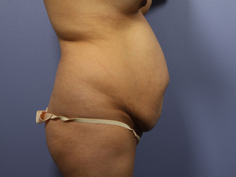 Tummy Tuck before and after photo