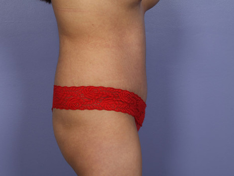 Tummy Tuck before and after photo