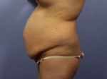 Tummy Tuck Before and after photo