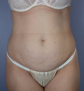 Tummy Tuck before and after photo