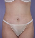 Tummy Tuck Before and after photo