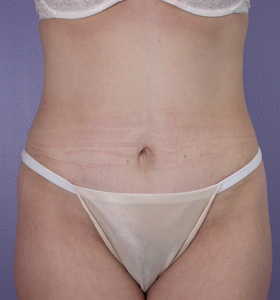 Tummy Tuck before and after photo